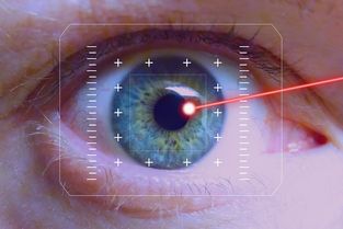 哺乳期做近视眼激光手术可以吗